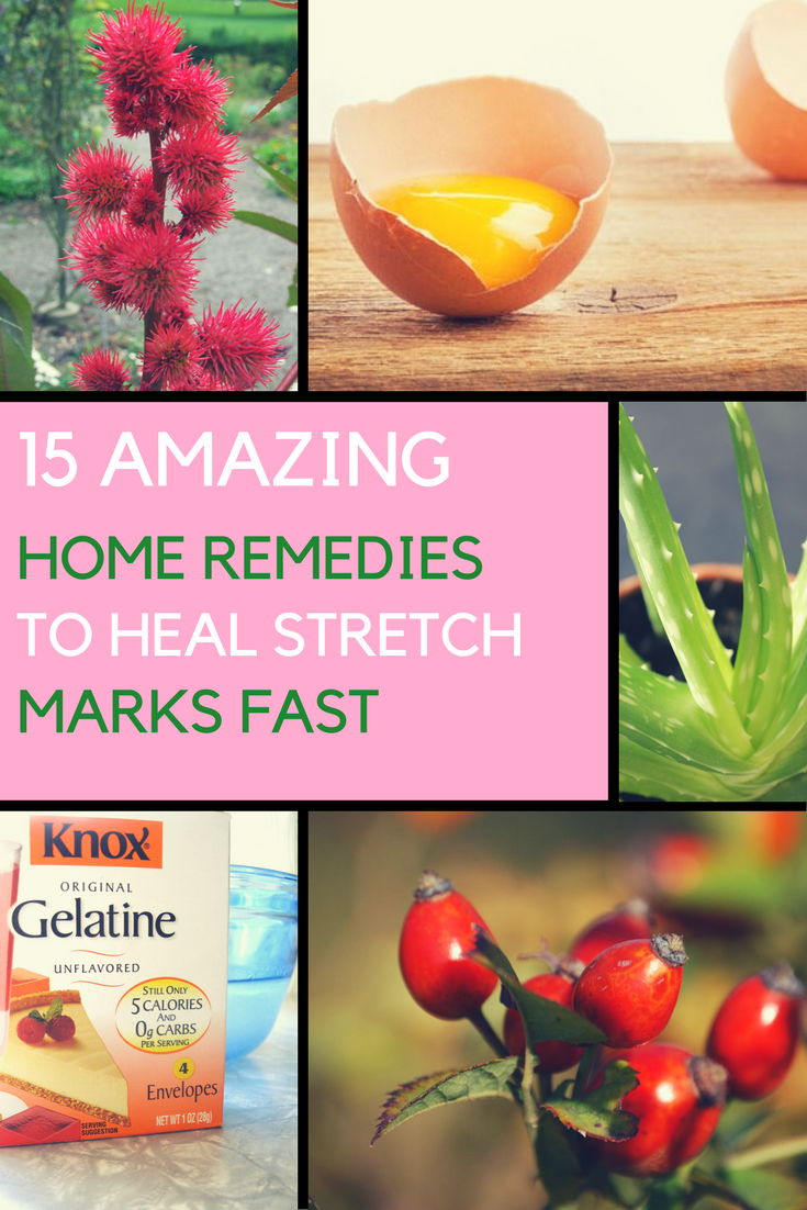 Get Rid of Stretch Marks Fast with THESE 10 Natural Remedies. | Ideahacks.com