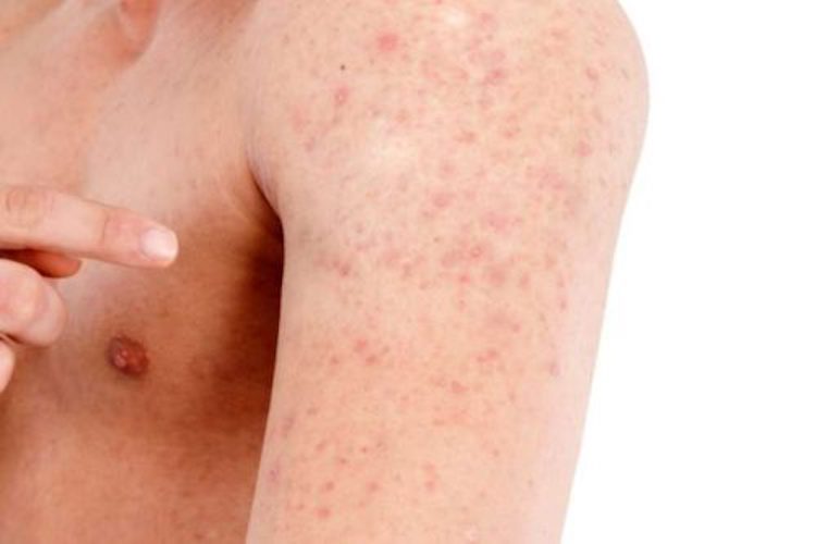 10 Keratosis Pilaris Treatment Ideas That Help Cure Chicken Skin