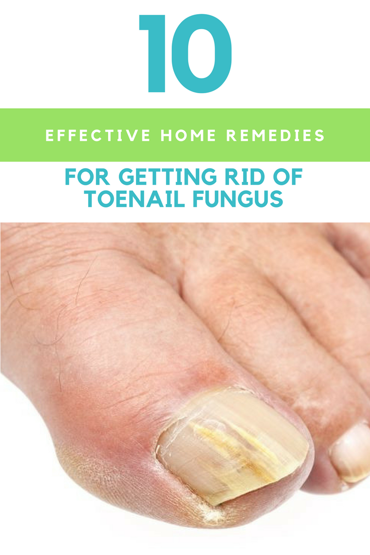 10 Effective Home Remedies For Getting Rid Of Toenail Fungus. | Ideahacks.com