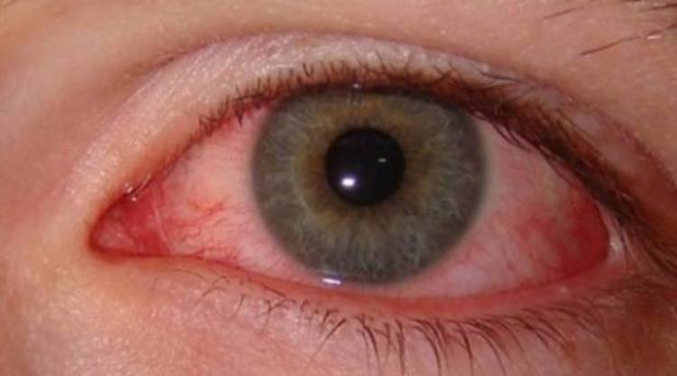 Remedies For Pink Eyes