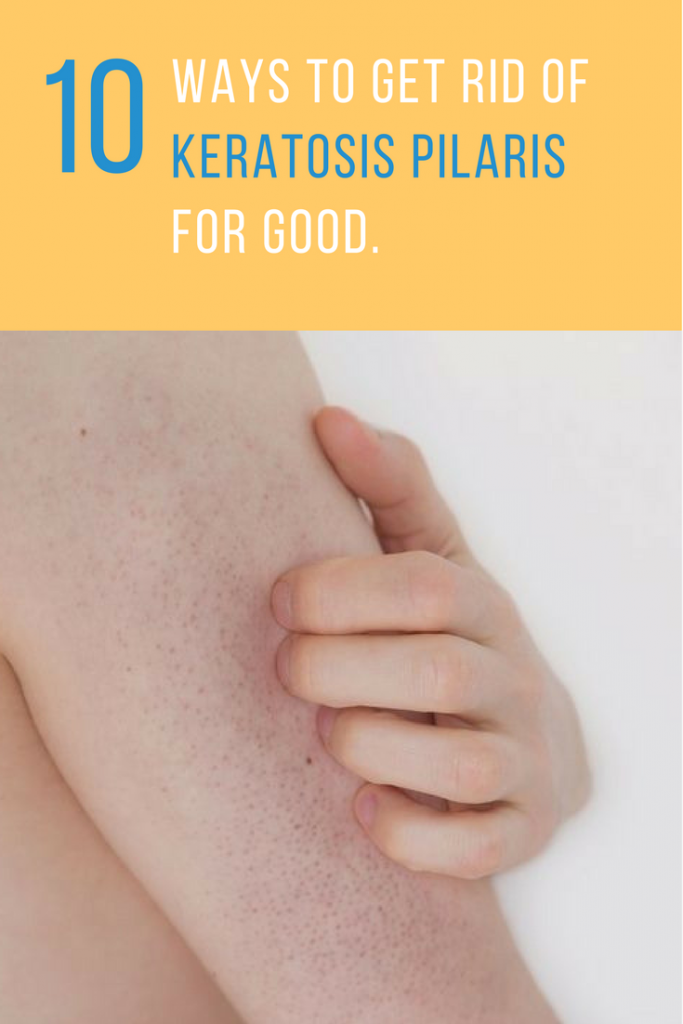 10 Keratosis Pilaris Treatment Ideas That Help Cure Chicken Skin