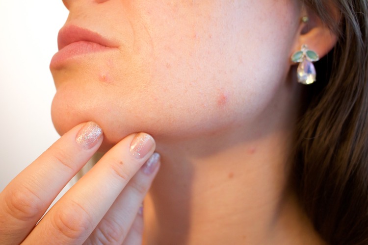 Do You Have Itchy Pimples On Your Skin Here Are 10 Ways To Deal