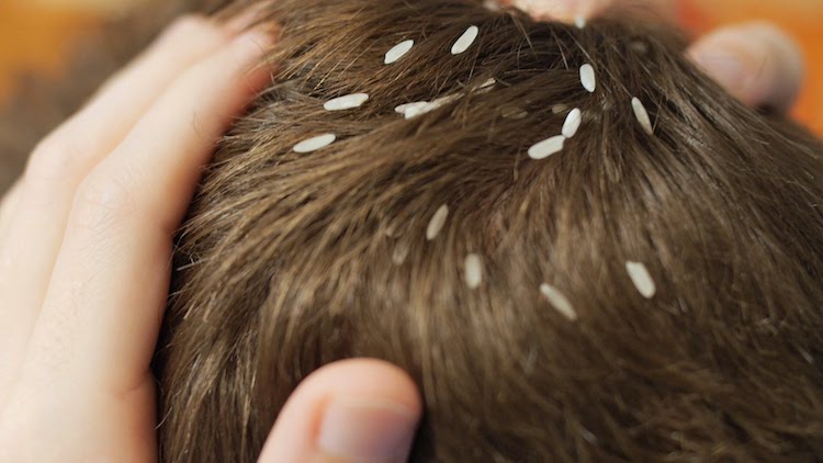 12 Home Remedies For Lice To Remove It