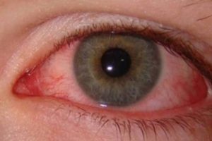 Remedies For Pink Eyes