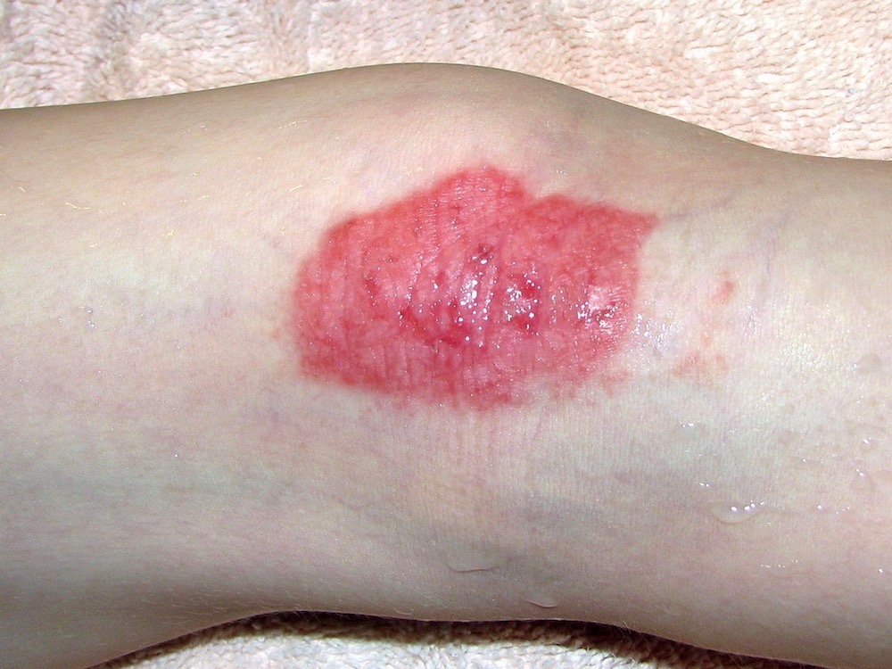 eczema on knee