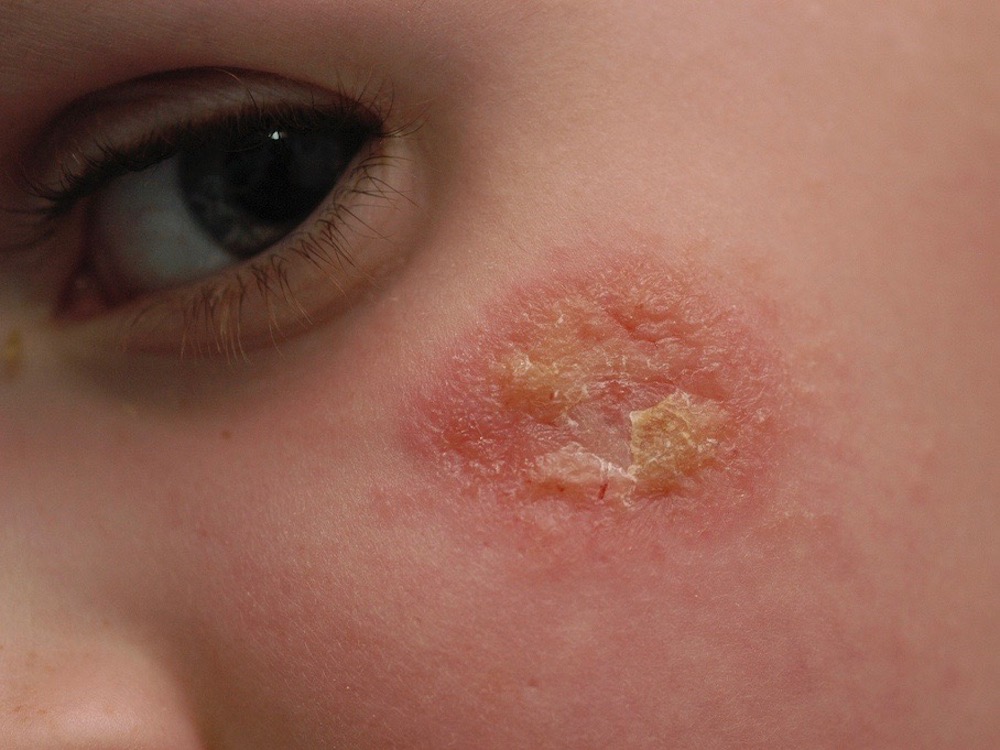 Eczema dry, scaly patches on the face