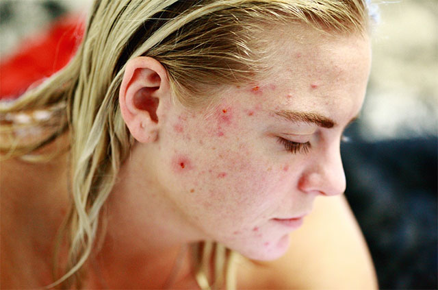 woman with severe acne problem